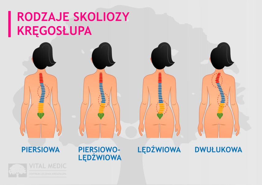 Skolioza to postępująca choroba, powodująca deformację...