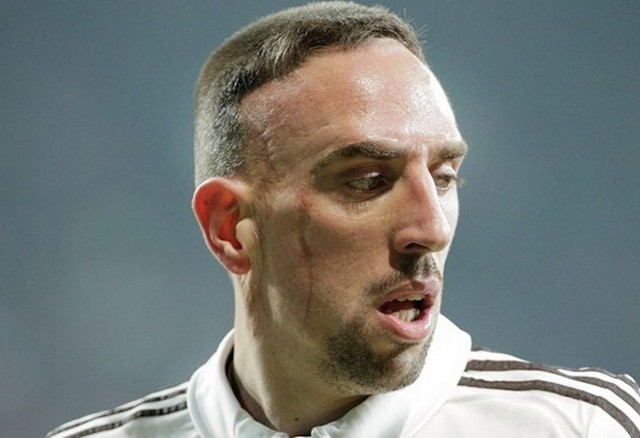 Franck Ribery i Arjen Robben na co dzień są pod opieką doktora Hansa-Wilhelma Müllera--Wohlfahrta i obaj szaleją w Bundeslidze. W Brazylii błyszczy tylko Holender, Francuz leczy kontuzję.