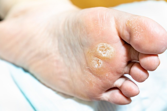 Zaawansowane odciski na stopach są trudne do leczenia, dlatego z problemem ich powstawania warto walczyć na bieżąco.