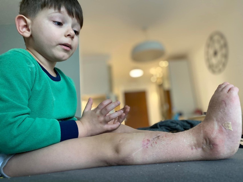 60 tysięcy złotych, by odzyskać sprawność. 4-letni Oluś z Krościenka Wyżnego potrzebuje kolejnej operacji