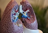 Tomografia płuc pomaga wykryć koronawirusa na wczesnym etapie. Tę metodę stosują już u niektórych pacjentów w SPSK4 w Lublinie