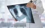Rak płuca to jeden z najgroźniejszych nowotworów. Jego pierwsze objawy można pomylić z przeziębieniem. Jak rozpoznać i leczyć raka płuc?
