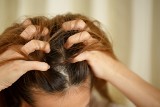Swędzenie głowy to nie zawsze łupież, nawet gdy łuszczy się naskórek. To pomoże przy objawach problemów ze skórą głowy
