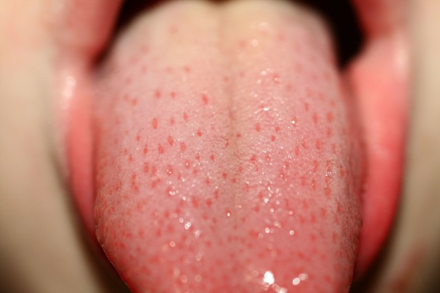 Pieczeniu języka, które jest objawem choroby, często towarzyszą też inne symptomy, takie jak: ból, biały nalot lub suchość w ustach. Piekący język często spowodowany jest kandydozą, przy której zalecana jest antybiotykoterapia.