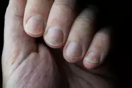 Czym jest onycholiza i co robić, gdy paznokieć odkleja się od palca? Co  jest przyczyną odwarstwiania się płytki i jak leczyć ten problem? | Strona  Zdrowia