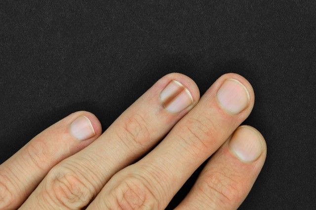 Czerniak paznokcia nie daje objawów bólowych, a jego cechą charakterystyczną jest pojawienie się zmiany pod paznokciem o ciemnym kolorze.