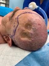 Operacja w Narodowym Instytucie Onkologii: Wycięli nowotwór, a potem pobrali płat z uda, by odtworzyć na jego głowie ubytek skórny
