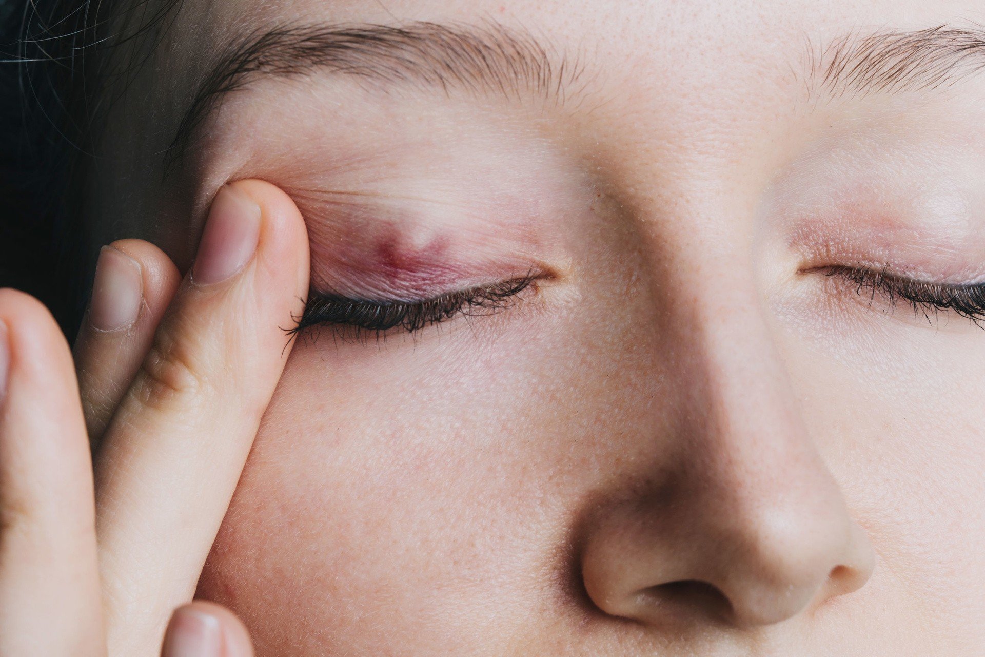 Gradówka w oku jest groźna! Przyczyny problemu i metody leczenia. Kiedy  stosować domowe sposoby, a kiedy konieczny jest zabieg usuwania? | Strona  Zdrowia