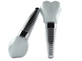 Fakty i mity na temat implantów zębowych                      