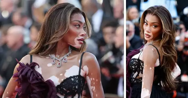 Supermodelka chora na bielactwo skradła show w Cannes! Trudno oderwać od niej wzrok!