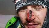 Wypadek Adama Bieleckiego na K2: Na alpinistę spadł głaz. Adam Bielecki ma złamany nos. Czy zdobędzie szczyt K2?