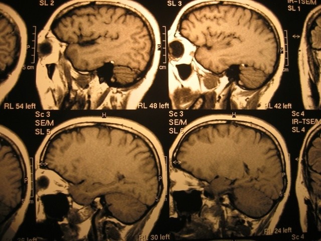 Do rehabilitacji neurologicznej kwalifikowani są chorzy m. in. po udarach mózgu, z zaburzeniem funkcji rdzenia kręgowego i korzeni nerwowych