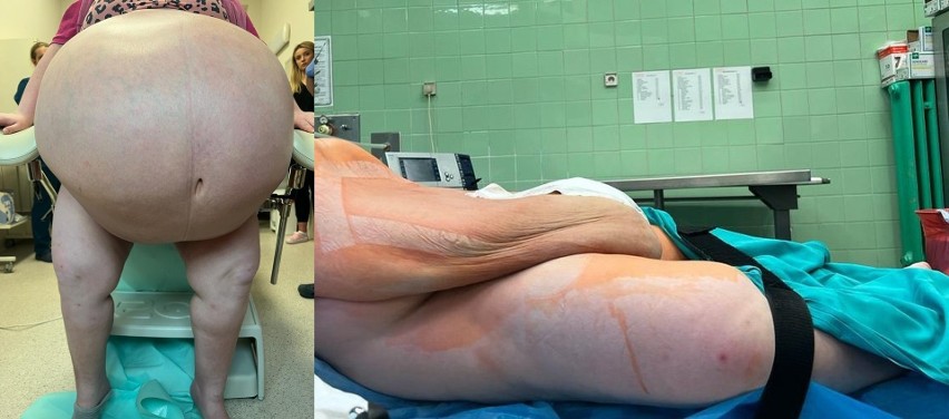 Lekarze ze szpitala uniwersyteckiego w Rzeszowie wycięli pacjentce prawie 100-kilogramowego guza