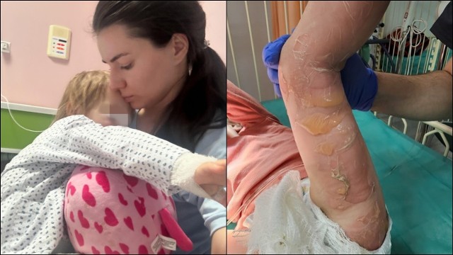 Mała Solomia ma poparzenia na nóżkach i rączkach. Spędziła ponad dwa tygodnie w szpitali.