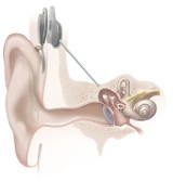 Leczenie niedosłuchu za pomocą implantów w Białymstoku. 