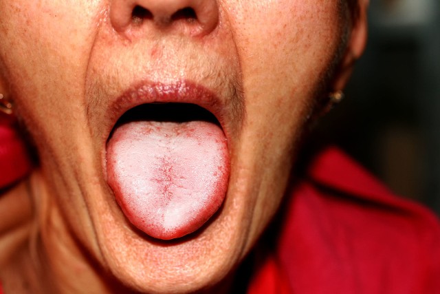 Częstą przyczyną gromadzenia się białego nalotu, która nie wskazuje na stany chorobowe, jest nieprawidłowa higiena jamy ustnej