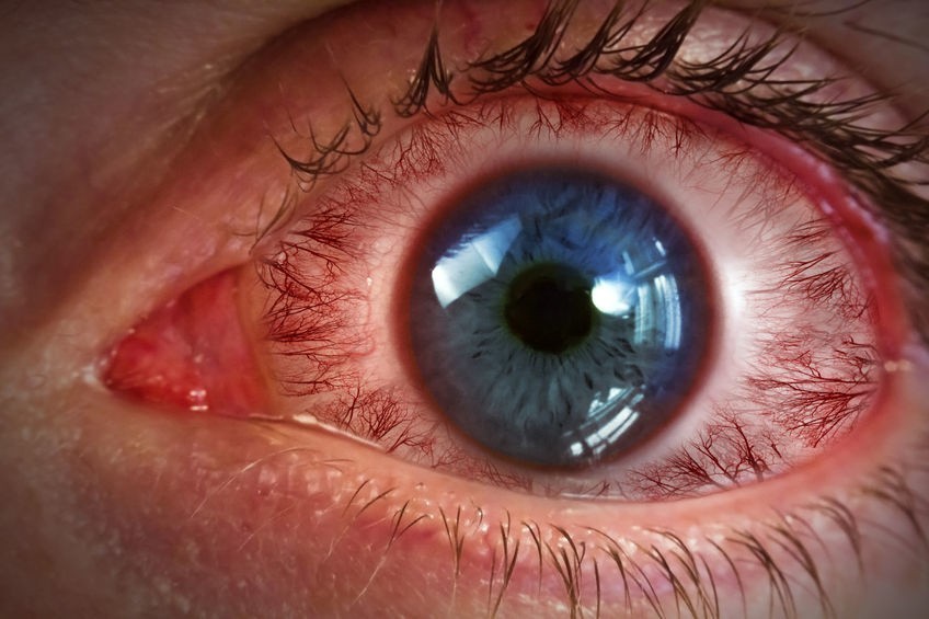 Zaczerwienie oczu może wynikać ze stanu zapalnego.