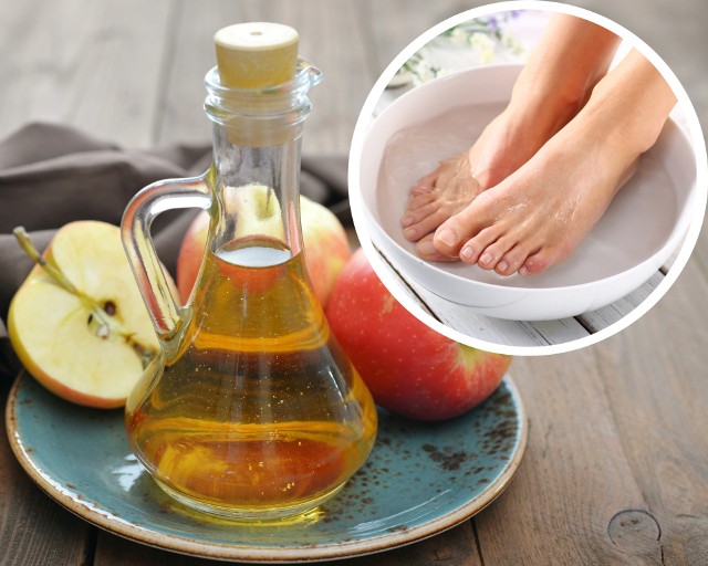 Ocet jabłkowy jest powszechnie stosowany we wspomaganiu leczenia egzemy i suchej skóry. Sprawdzi się także w pielęgnacji stóp.