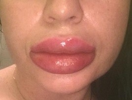 Tak wyglądały usta pani Natalii po zabiegu u kosmetyczki z...