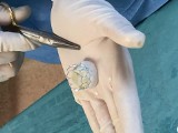 86-letniej Opolance wszczepiono w Uniwersyteckim Szpitalu Klinicznym w Opolu najnowocześniejszą na świecie zastawkę aortalną 