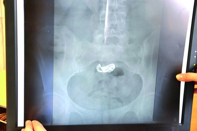 Zdjęcie rentgenowskie żołądka 27-latki. W środku bransoletka.