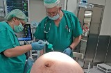Ginekolodzy z Jasła usunęli 70-letniej kobiecie 30-kilogramowego guza. Pacjentka nie wiedziała, że go ma [ZDJĘCIA]