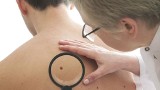 Bezpłatne badania profilaktyczne wykrywające nowotwory skóry. Gdzie można je zrobić?