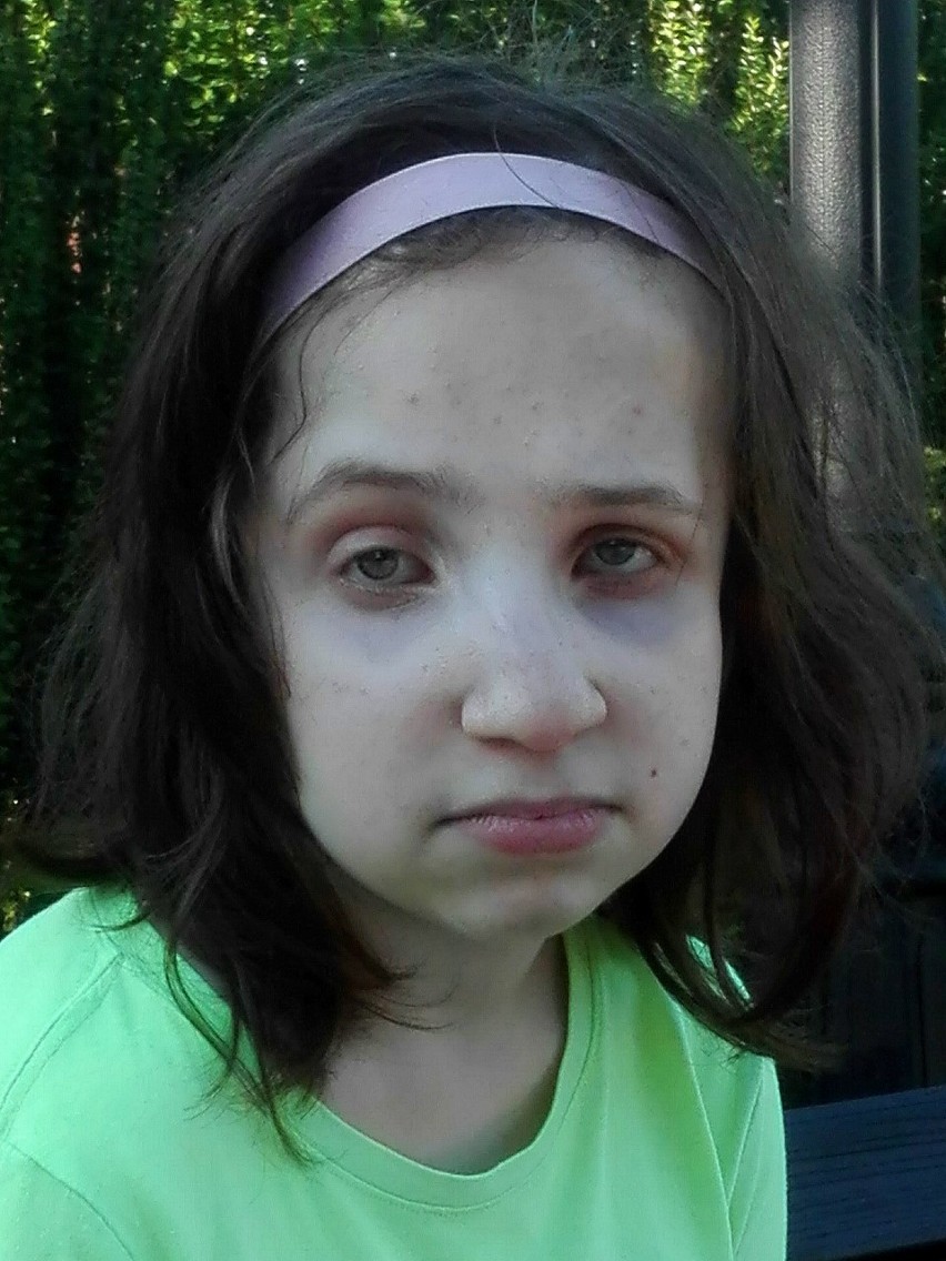 Rodzice 14-letniej Julii Skurskiej z Sandomierza proszą o wsparcie dla córki, którą czeka kosztowna operacja kolan w Stanach Zjednoczonych