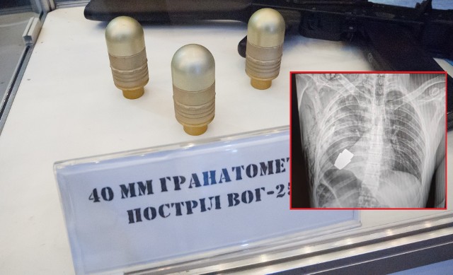 W ciele ukraińskiego żołnierza utkwił pocisk z granatnika. Lekarzom udało się go usunąć.