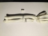 Wydrukowane w 3D implanty z ChM ratują rączkę 10-letniej dziewczynki