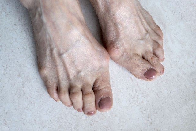 Deformacje stopy często idą w parze, np. obok palców młoteczkowatych rozwija się haluks.