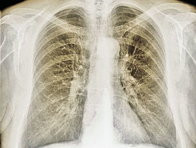 Widoczne na zdjęciu RTG nacieki gruźlicze w płucach chorego z zaawansowanym stadium.