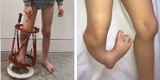 Czterolatka miała niedorozwiniętą kość piszczelową nogi. Dzięki poznańskim chirurgom uniknęła amputacji