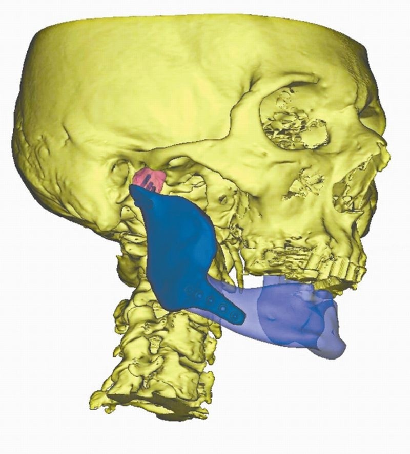 Białostocka spółka ChM wydrukowała implant kości żuchwy 