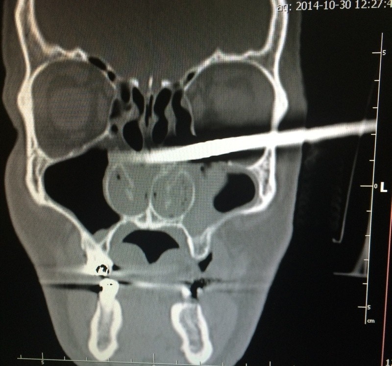 Metalowy pręt wszedł z boku głowy, poniżej gałki ocznej, i...