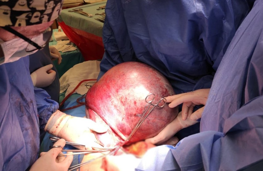 Kobieta miała guza jajnika, który ważył 30 kilogramów. Zoperowali ją lekarze w szpitalu w Krośnie [ZDJĘCIA]