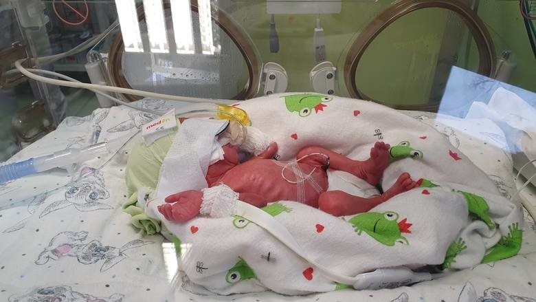 Pięcioraczki z Gniezna urodzone w szpitalu na Polnej dostaną duże wsparcie finansowe