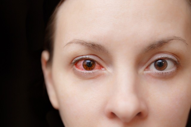 Wylew w oku najczęściej nie stanowi powodu do niepokoju. Niekiedy jednak może świadczyć o poważnych problemach ze zdrowiem.