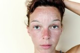 Skąd się biorą białe plamy na skórze i kiedy mogą być spowodowane chorobą? Czy można pozbyć się białych plam na ciele albo twarzy?
