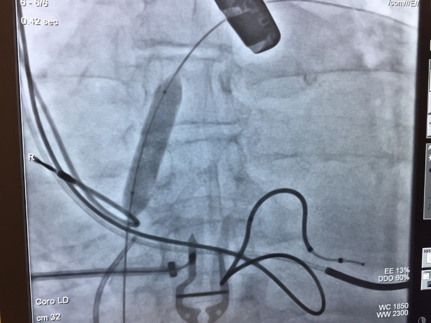 Lekarze kardiolodzy wykonali innowacyjne zabiegi w wejherowskim szpitalu [zdjęcia].