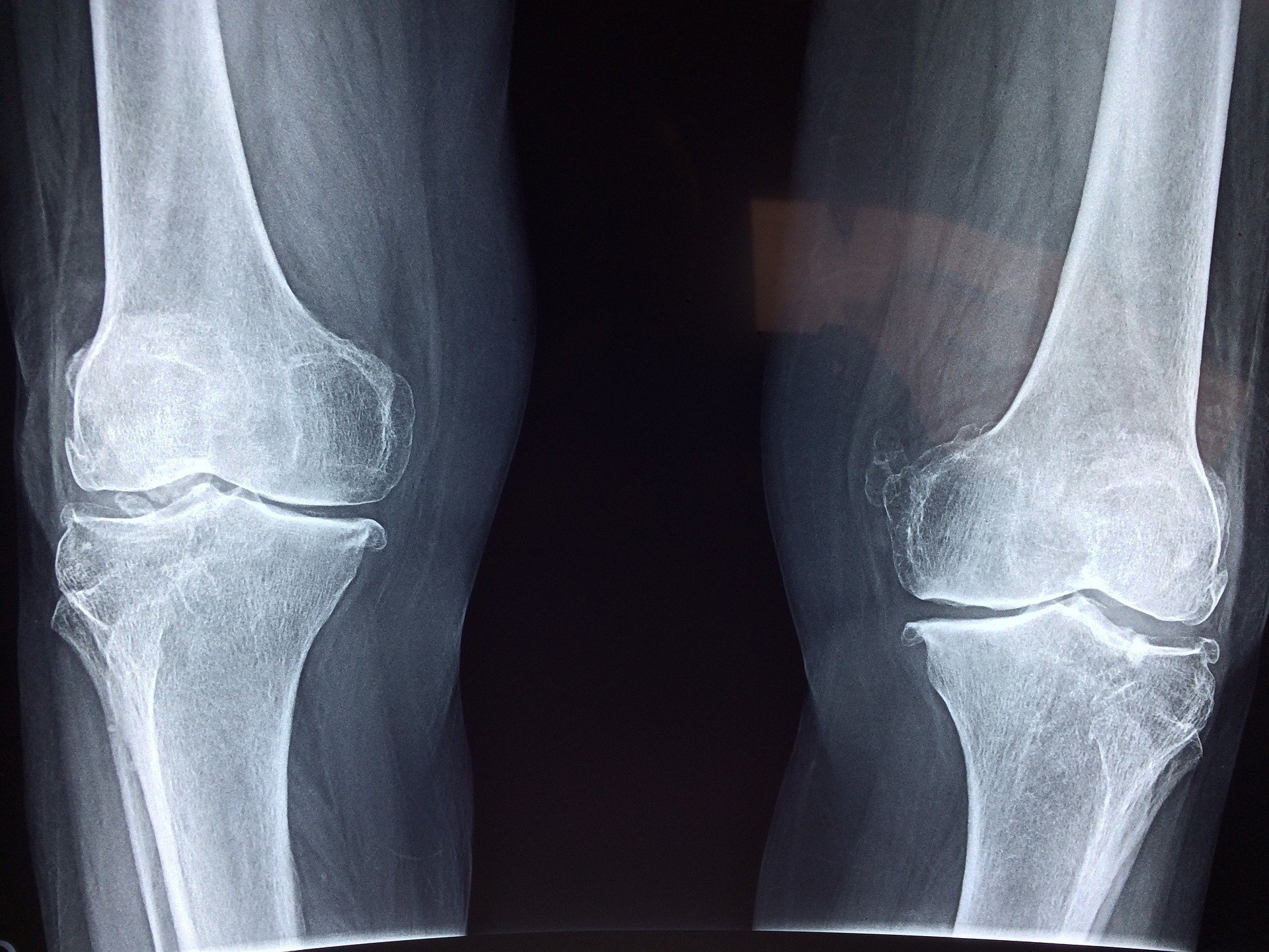 Staw kolanowy – budowa i funkcje. Jakie są najczęstsze urazy stawu  kolanowego? | Strona Zdrowia