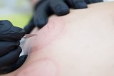 Skaryfikacja, czyli tatuaż blizn. Na czym polega ta modyfikacja ciała i jak się ją wykonuje?