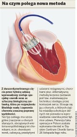 Pionierska operacja zastawki serca w Zabrzu
