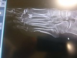 Soczi 2014. Kowalczyk z wielowarstwowym złamaniem stopy [WIDEO]