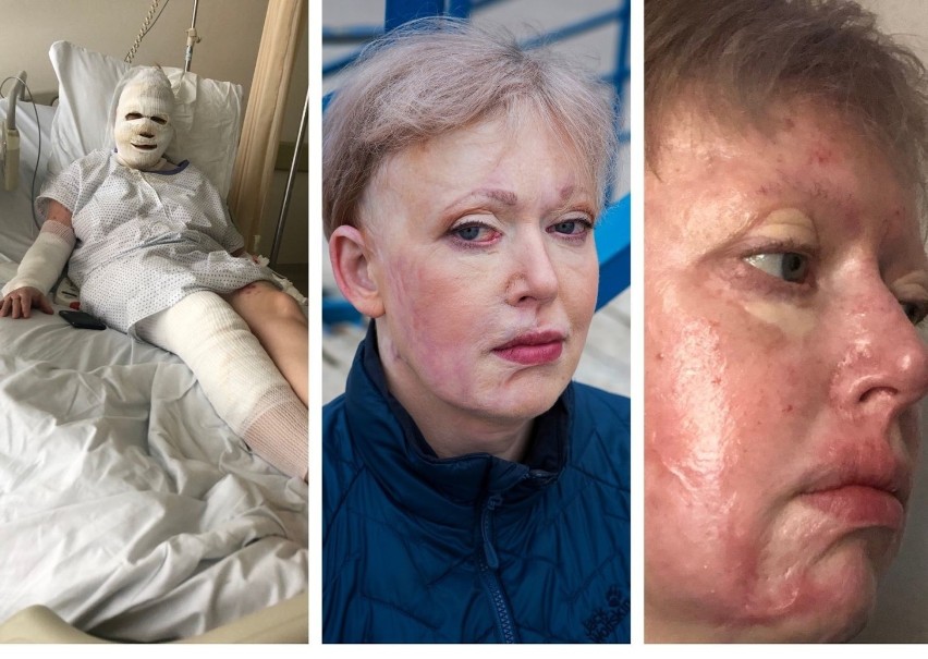 Gdańsk: Kobieta oblana kwasem siarkowym zbiera pieniądze leczenie. Sprawca nadal atak pozostaje nieuchwytny