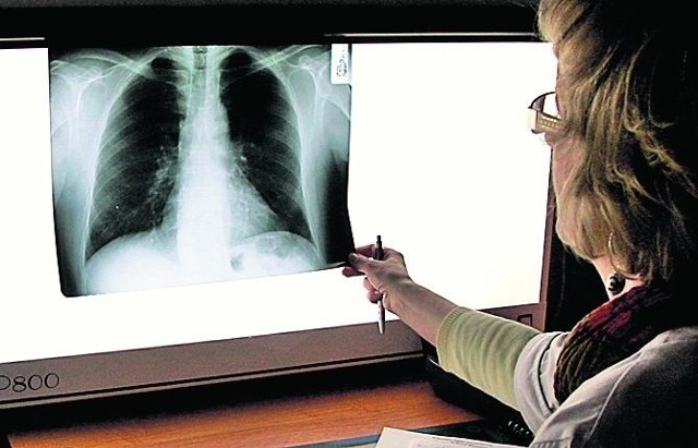 Prześwietlenie płuc to pierwszy krok do wykrycia gruźlicy
