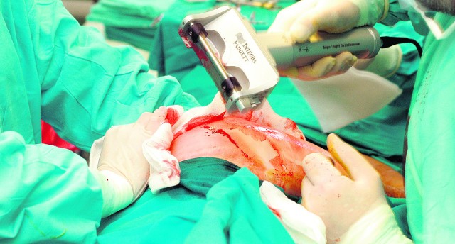 Szpital dziecięcy w krakowskim Prokocimiu słynie z operacji z użyciem sztucznej skóry (integry) do przeszczepów