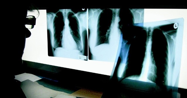 Na zdjęciach rentgenowskich nie można rozpoznać nowotworu, gdy jest w bardzo wczesnym stadium