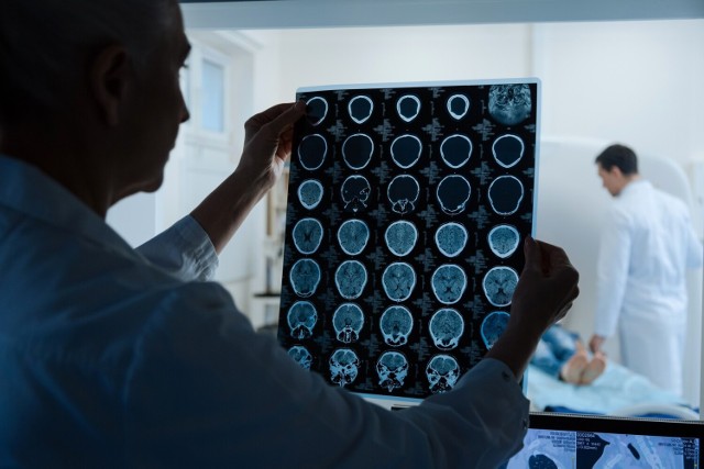 Drobne zmiany ogniskowe w mózgu po przebyciu COVID-19 często odkrywane są jakiś czas po infekcji, gdy wykonywana jest tomografia komputerowa.