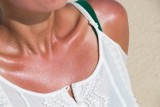 Co na oparzenie słoneczne? Poznaj 9 naturalnych sposobów na złagodzenie skutków poparzeń. Jak rozpoznać ich objawy i czym smarować skórę?